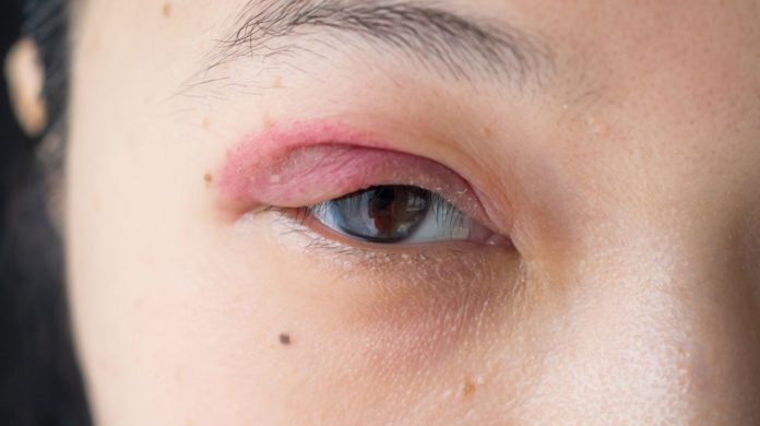 7 Spring Eye Problems You Didn’t Know You Had!