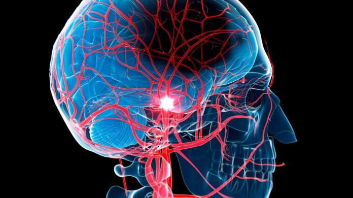 Eye Stroke Eye Stroke?