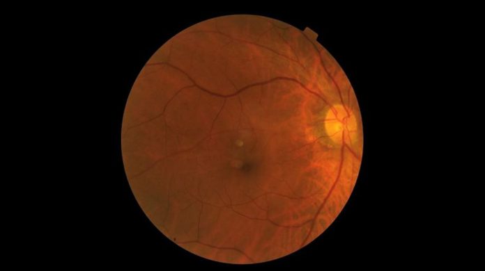 Macular Degeneration 101 Macular Degeneration 101