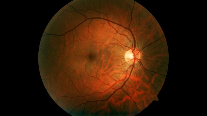 Stargardt Disease Causes, Symptoms & Latest Treatments Stargardt Disease Causes, Symptoms & Latest Treatments