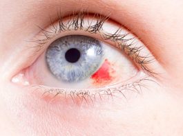 The Eye Condition That Affects 1 in 3 People
