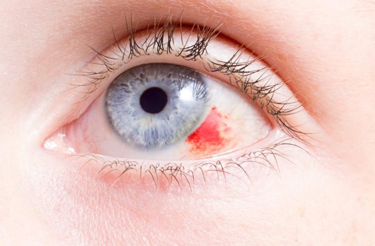 The Eye Condition That Affects 1 in 3 People