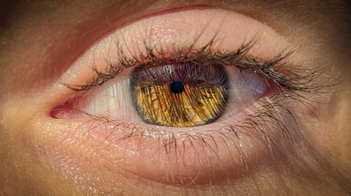 Meibomian Gland Dysfunction Meibomian Gland Dysfunction