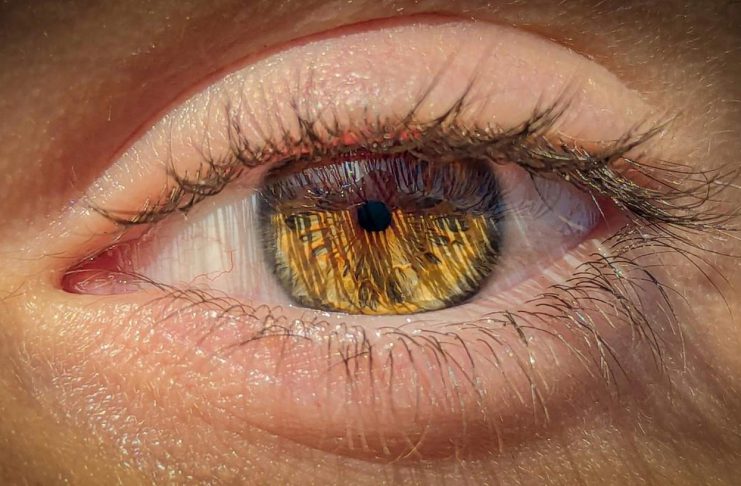 Meibomian Gland Dysfunction