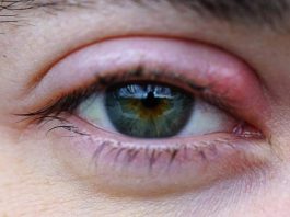 What Causes a Stye on the Eyelid