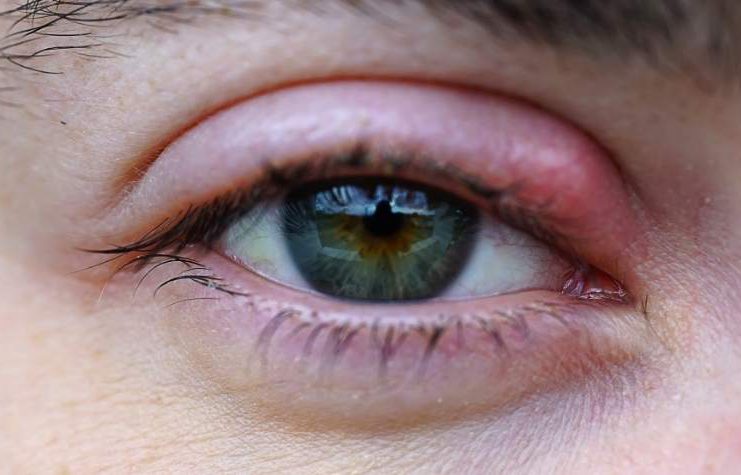 What Causes a Stye on the Eyelid